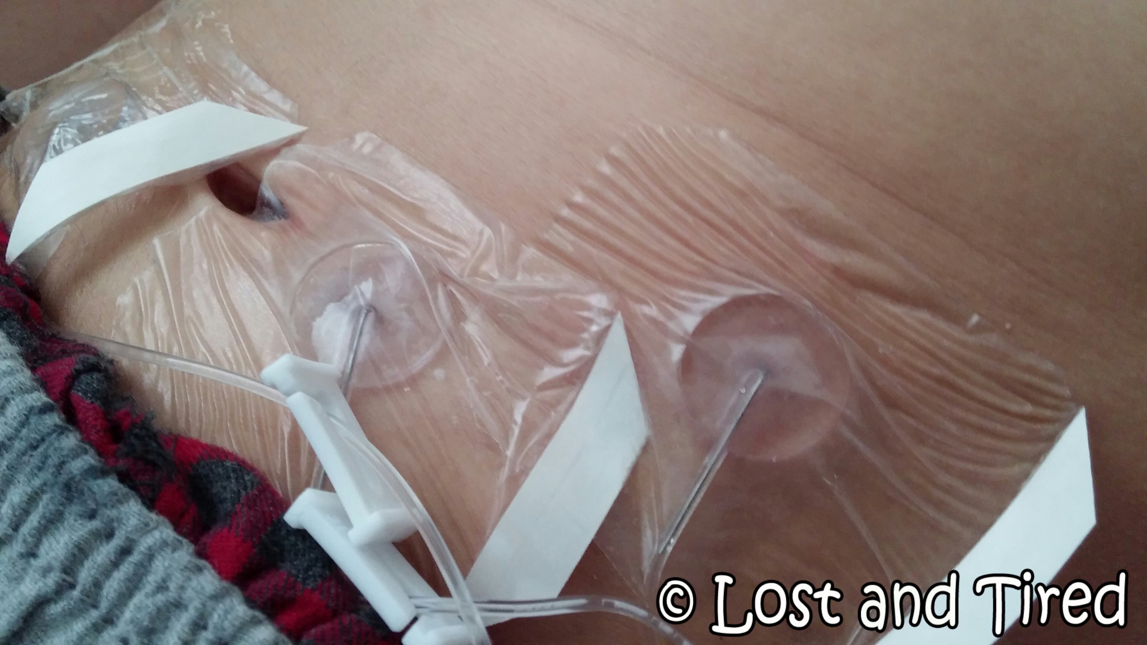 Great News - Gavin's 3rd Subcutaneous #IVIG Infusion was a Success