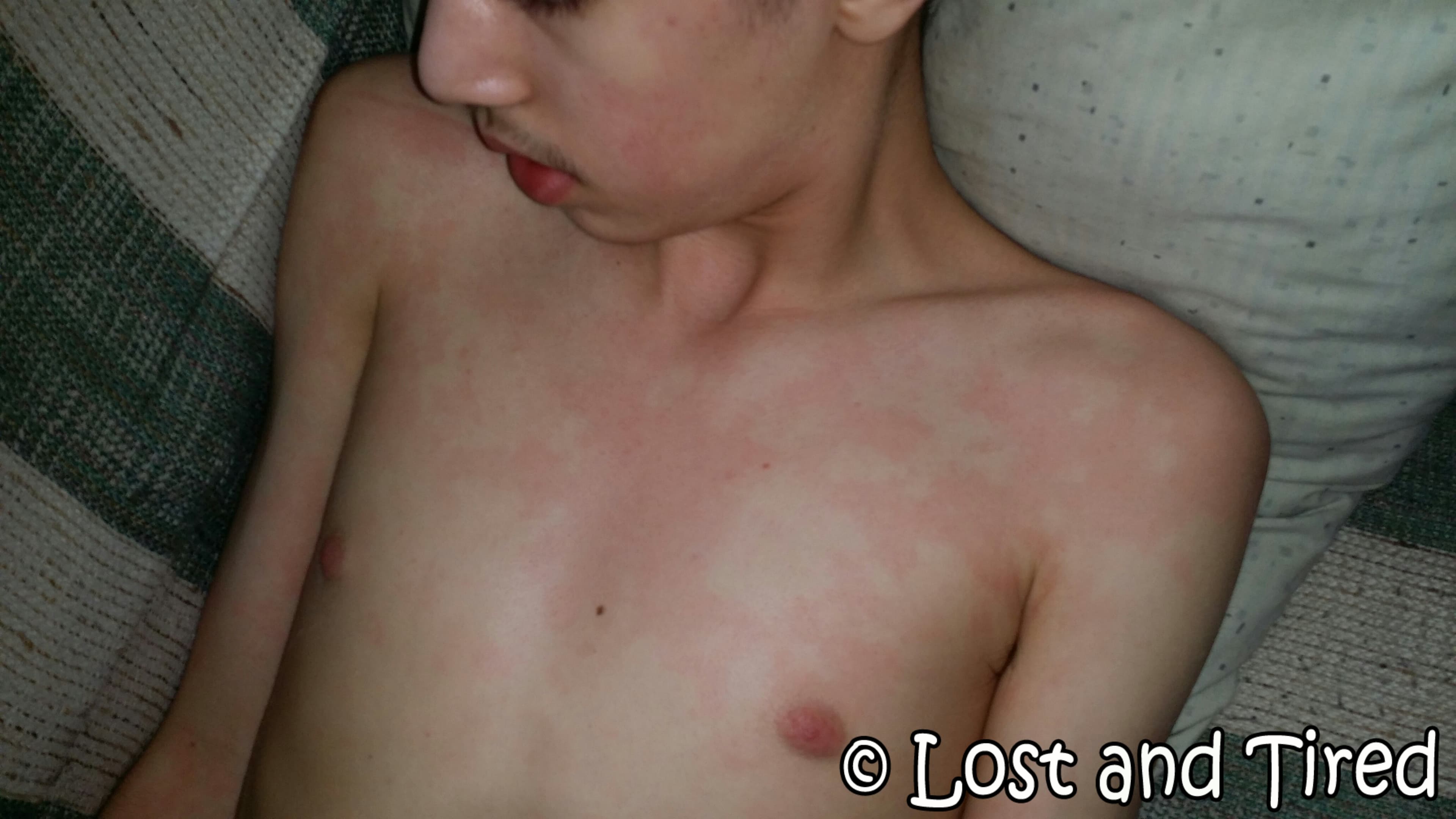 Scary Stuff - Gavin had an Autonomic Crisis during his #IVIG infusion today