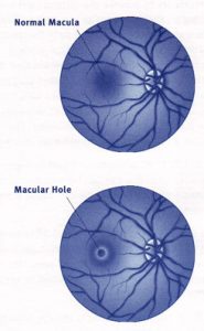 Read more about the article Can macular holes cause migraines??