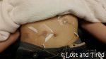 Subcutaneous IVIG – We’re officially underway