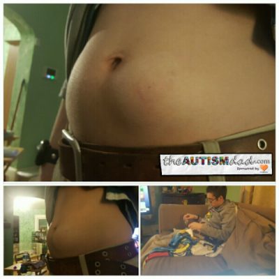 Read more about the article What his stomach looks like after an IVIG infusion 